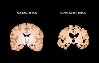 Alzheimer's and Normal Brains, Comparison - Album alb3784807