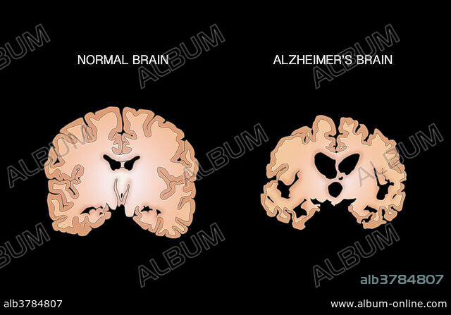 Alzheimer's and Normal Brains, Comparison - Album alb3784807