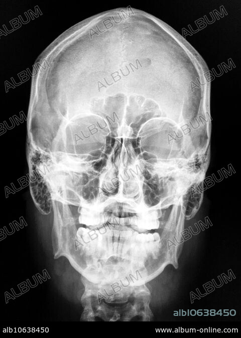 Frontal X-ray of Skull - Album alb10638450