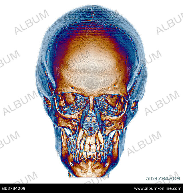 💀 Fractured Human Skull Replica・ STL File for 3D printing