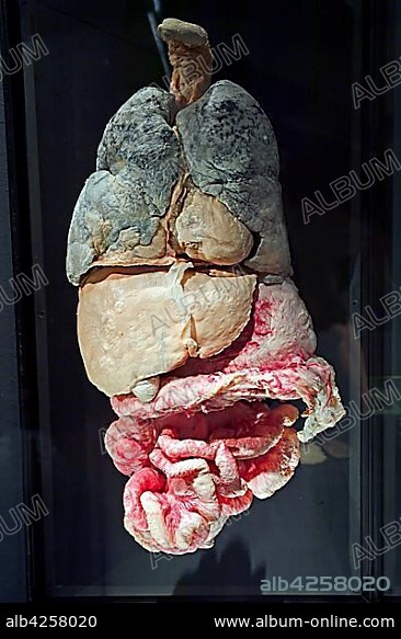 Plastinate, human abdomen, internal organs with metastases, Body Worlds, Menschen Museum, Berlin, Germany, Europe.
