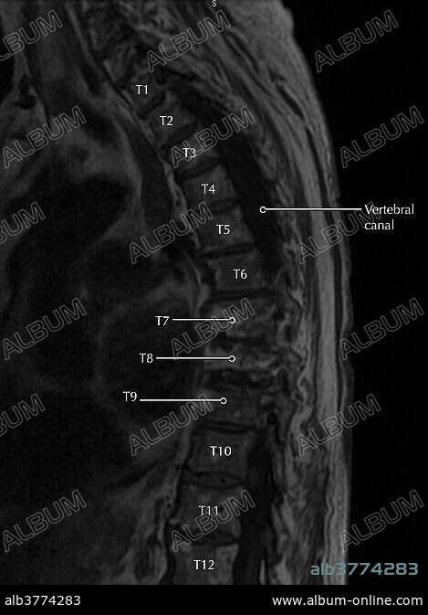 Surgical outcome of upper extremity fractures in patients