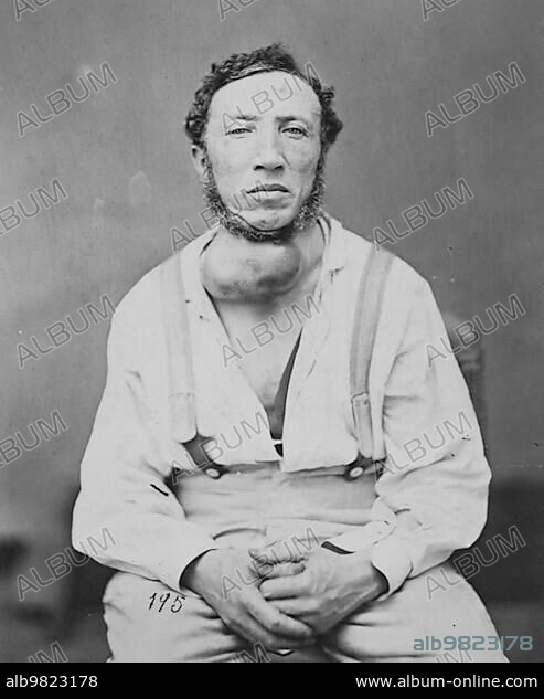 Joseph Brown; Aneurysm of the Innominate Artery; from the Photographic Catalogue of the Department of Surgery; 1880; Photograph by William Bell; Historic; digitally restored reproduction from an original of the period.