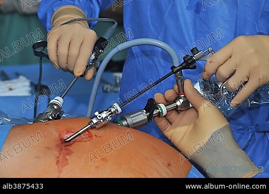 Laparoscopy, Germany, Europe.