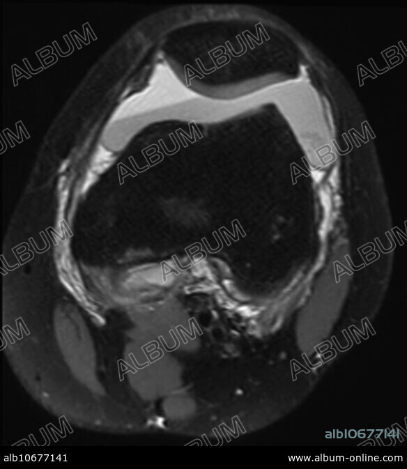 Hemarthrosis, MRI - Album alb10677141