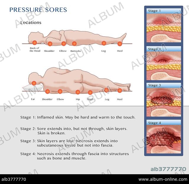 Pressure Ulcers/Decubitus: Causes, Symptoms And Treatment