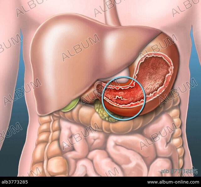 Abdominal x-ray Information | Mount Sinai - New York