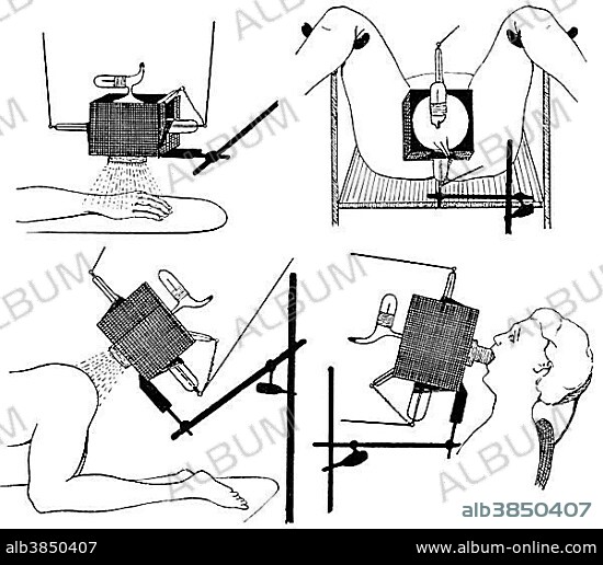 Irradiation of the hand, mouth, genital and anal regions, state of the art of therapeutic techniques, early 20th Century, illustration.