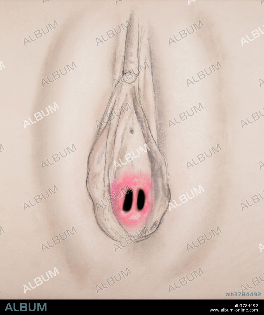 In a septate hymen a dividing membrane partially blocks the vaginal entrance. The openings in a septate hymen are usually large enough for the menstrual flow to escape but minor surgery is often required to allow for the insertion of tampons or for sexual intercourse.