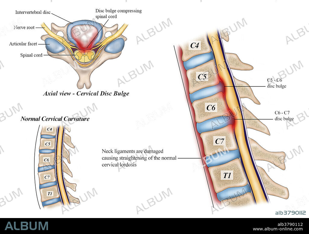 Cervical Lordosis Straightening, Illustration