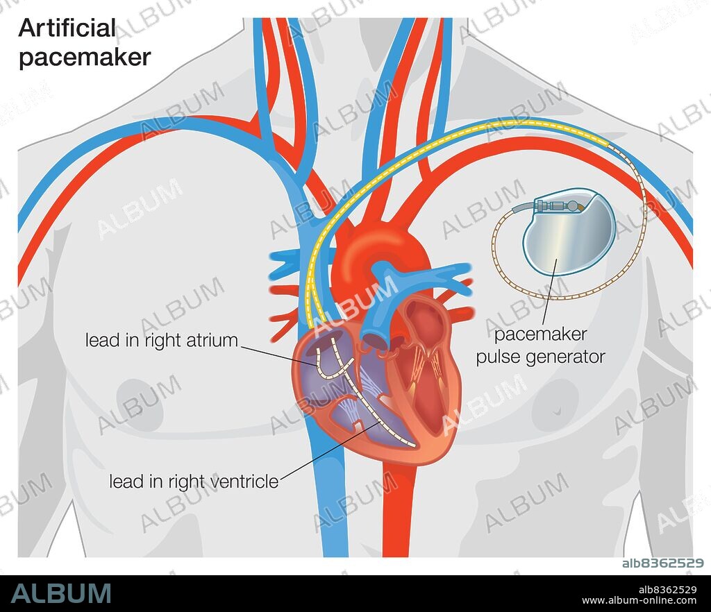 Diagram of an artificial pacemaker.