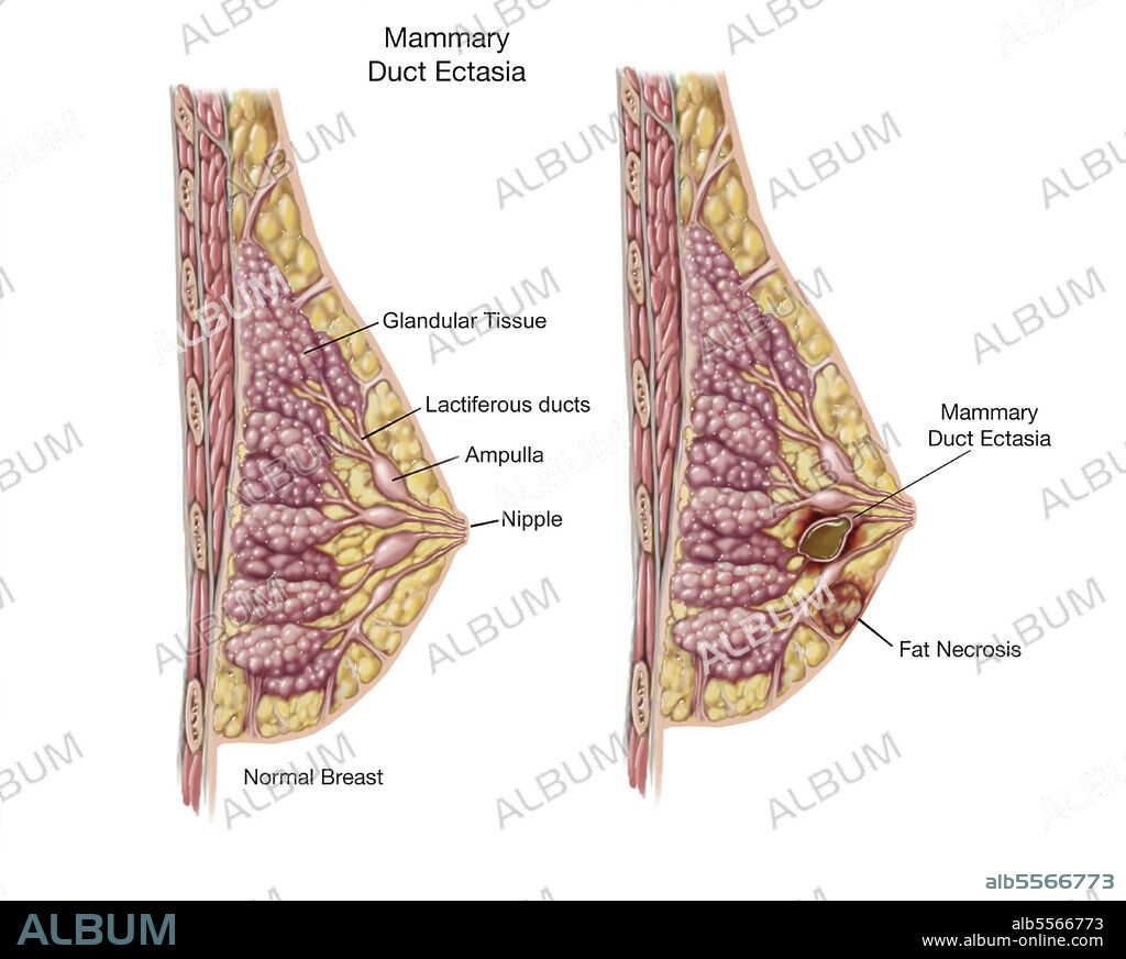 Biomedical illustration of mammary duct ectasia in the female breast.