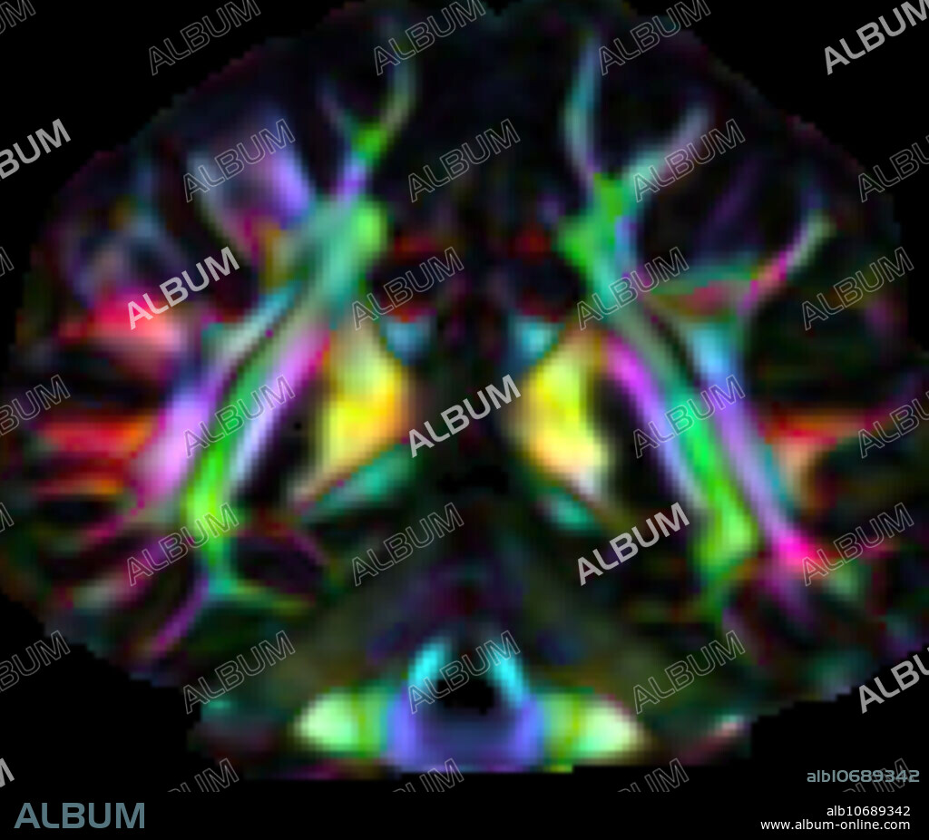 This coronal (from the front) colour DTI (diffusion tensor imaging) image depicts the major white matter tracts in the brain. By convention tracts oriented from anterior to posterior (front to back) are green, tracts oriented from side to side are red and those tracts oriented superior to inferior (head to toe) are blue.