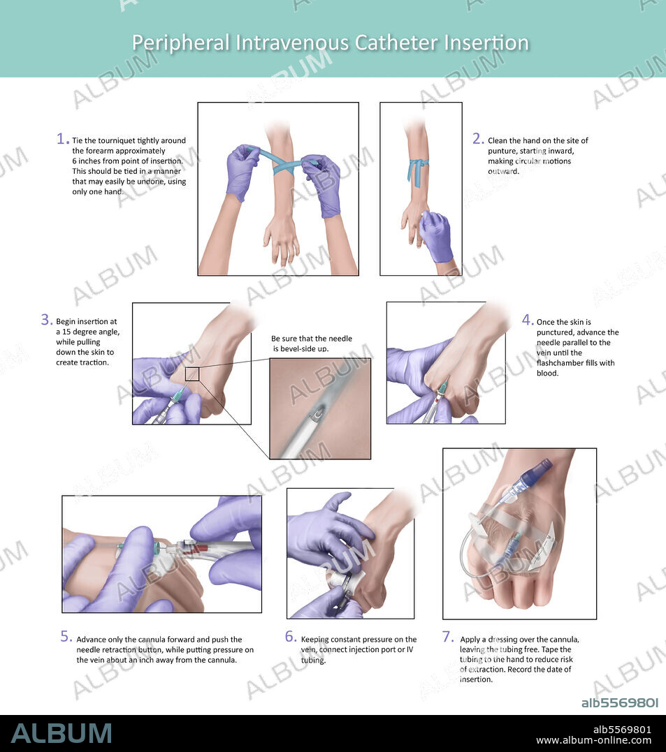 Step-by-step medical illustration depicting the proper placement of a peripheral intravenous catheter insertion.
