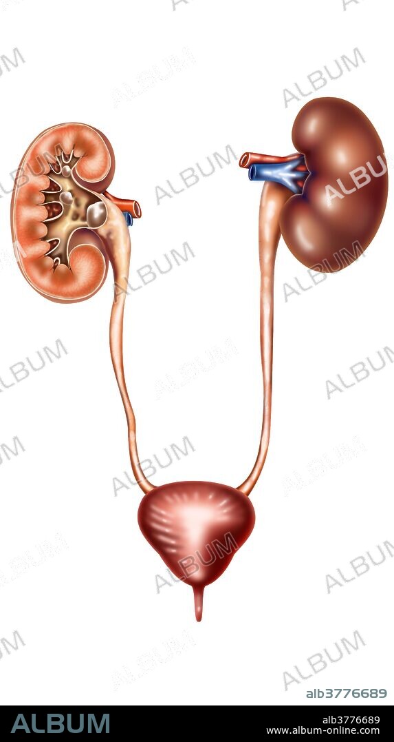 A kidney stone, also known as a renal calculus is a solid concretion or crystal aggregation formed in the kidneys from dietary minerals in the urine. Urinary stones are typically classified by their location in the kidney (nephrolithiasis), ureter (ureterolithiasis), or bladder (cystolithiasis), or by their chemical composition (calcium-containing, struvite, uric acid, or other compounds). Kidney stones typically leave the body by passage in the urine stream, and many stones are formed and passed without causing symptoms. If stones grow to sufficient size they can cause obstruction of the ureter. Ureteral obstruction causes postrenal azotemia and hydronephrosis (distension and dilation of the renal pelvis and calyces), as well as spasm of the ureter. This leads to pain, most commonly felt in the flank (the area between the ribs and hip), lower abdomen and groin (a condition called renal colic). .When a stone causes no symptoms, watchful waiting is a valid option. For symptomatic stones, pain control is usually the first measure, using medications such as non-steroidal anti-inflammatory drugs (NSAIDs) or opioids. More severe cases may require surgical intervention. For example, some stones can be shattered into smaller fragments using extracorporeal shock wave lithotripsy (ESWL). Some cases require more invasive forms of surgery. Examples of these are cystoscopic procedures such as laser lithotripsy, or percutaneous techniques such as percutaneous nephrolithotomy. Sometimes, a tube (ureteral stent) may be placed in the ureter to bypass the obstruction and alleviate the symptoms, as well as to prevent ureteral stricture after ureteroscopic stone removal.