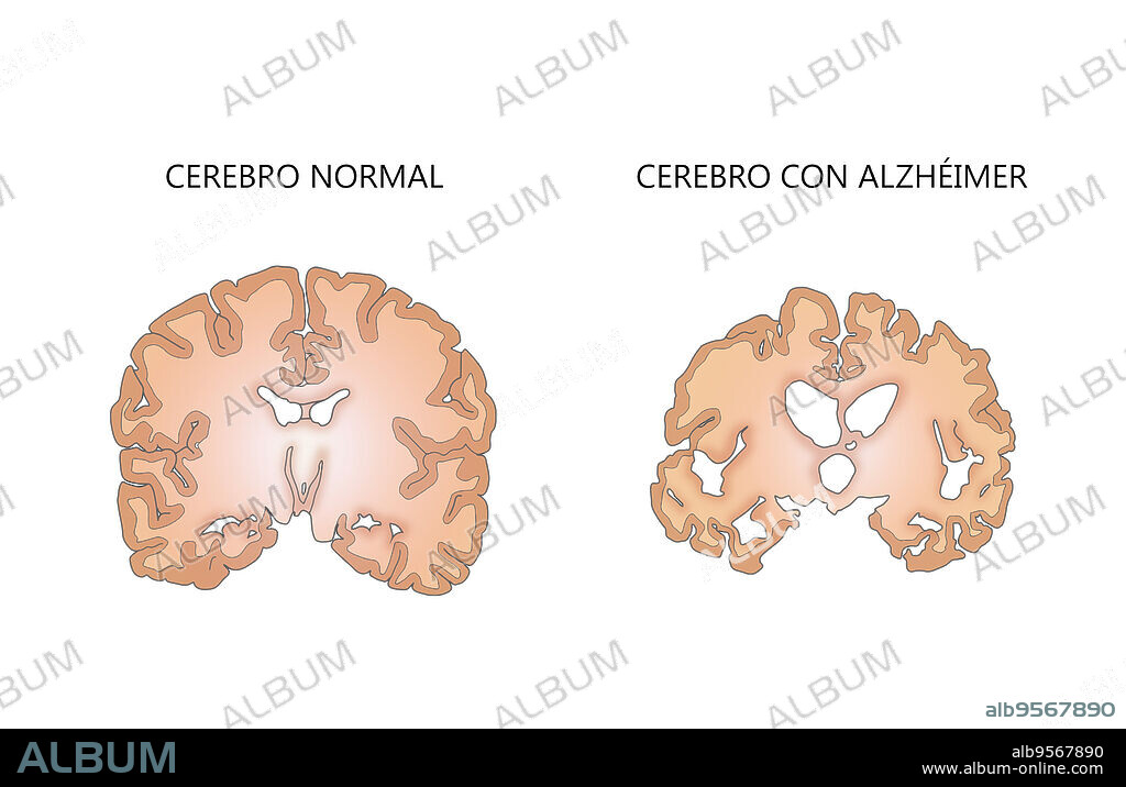 Illustration comparing a normal brain (left) with a brain suffering from Alzheimer's disease (right).