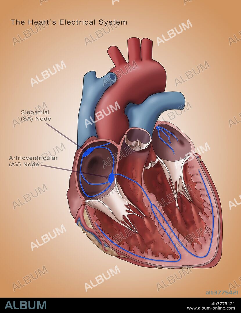 Illustration depicting the heart's electrical system. Annotated are the Sinoatrial node and the atrioventricular node. The sinoatrial (SA) node (thick purple oval upper left) consists of self-excitatory muscle cells that contract rhythmically at around 70 beats per minute. Following each contraction, an impulse spreads through the heart's upper chambers (atria, upper frame) to the atrioventricular (AV) node (thick purple oval opposite SA node). Contraction of the atria causes blood to move into the lower chambers (ventricles, lower frame).