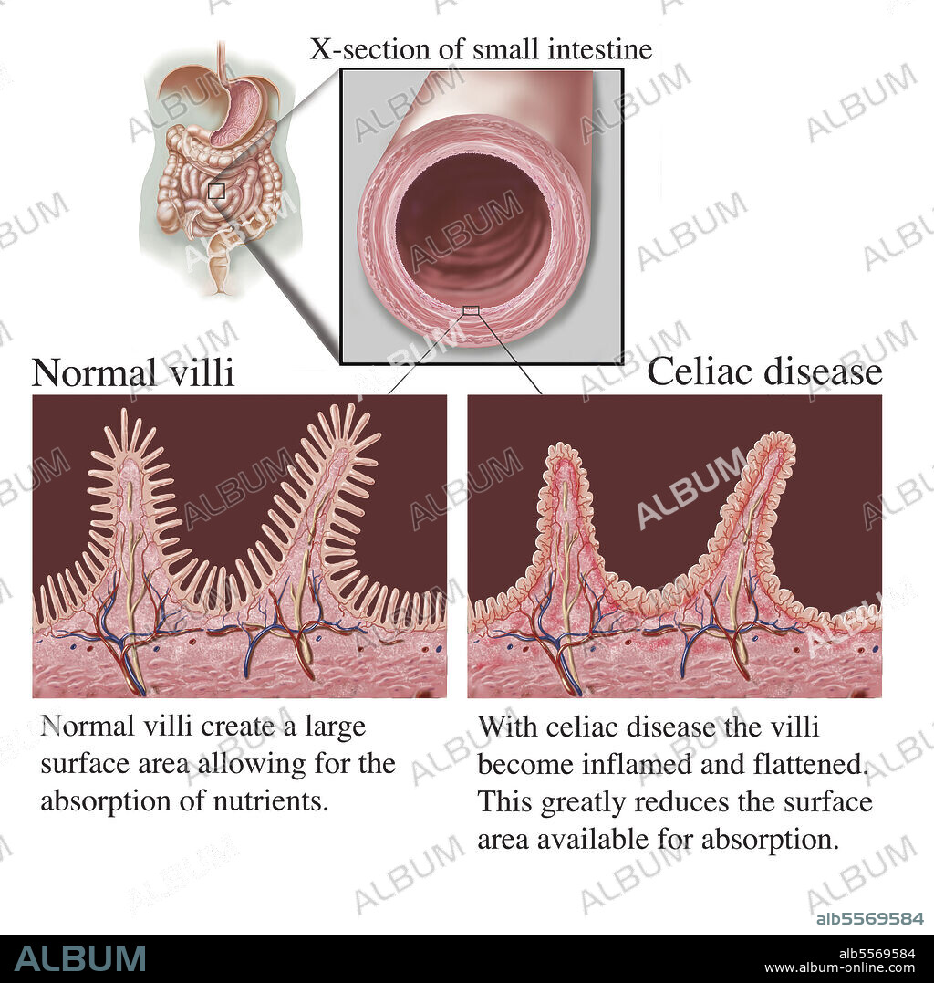 Cross section of intestine showing destruction of villi due to celiac disease, with text description.