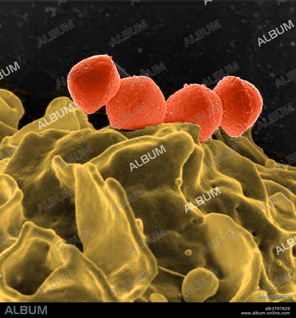Colorized scanning electron micrograph of Streptococcus pyogenes bacteria (orange) bound to a human neutrophil (yellow). These gram-positive bacteria are rounded or spherical cocci. They typically form chains of cells, as seen here. Healthy humans may carry these bacteria harmlessly in their throat or nose. Pathogenic strains of s. pyogenes, however, cause infections of the skin (including impetigo), the uterus following childbirth (puerperal sepsis), and the bloodstream (septicemia). S. pyogenes accounts for the high incidence of sore throats, tonsillitis, and middle ear infections (otitis media) in children. Treatment is with penicillin-drugs.