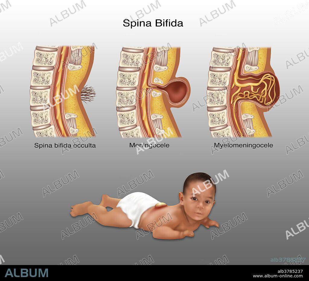 An illustration of the different types of spina bifida and a baby with spina bifida. Spina bifida is caused by the incomplete closing of the embryonic neutral tube. A development congenital disorder, vertebrae remain incomplete (open) in their formation. If the opening is large enough the spinal chord emerges through the bone. 1 baby in 30 is born with one or more major birth defects. Most are correctable with modern surgery.
