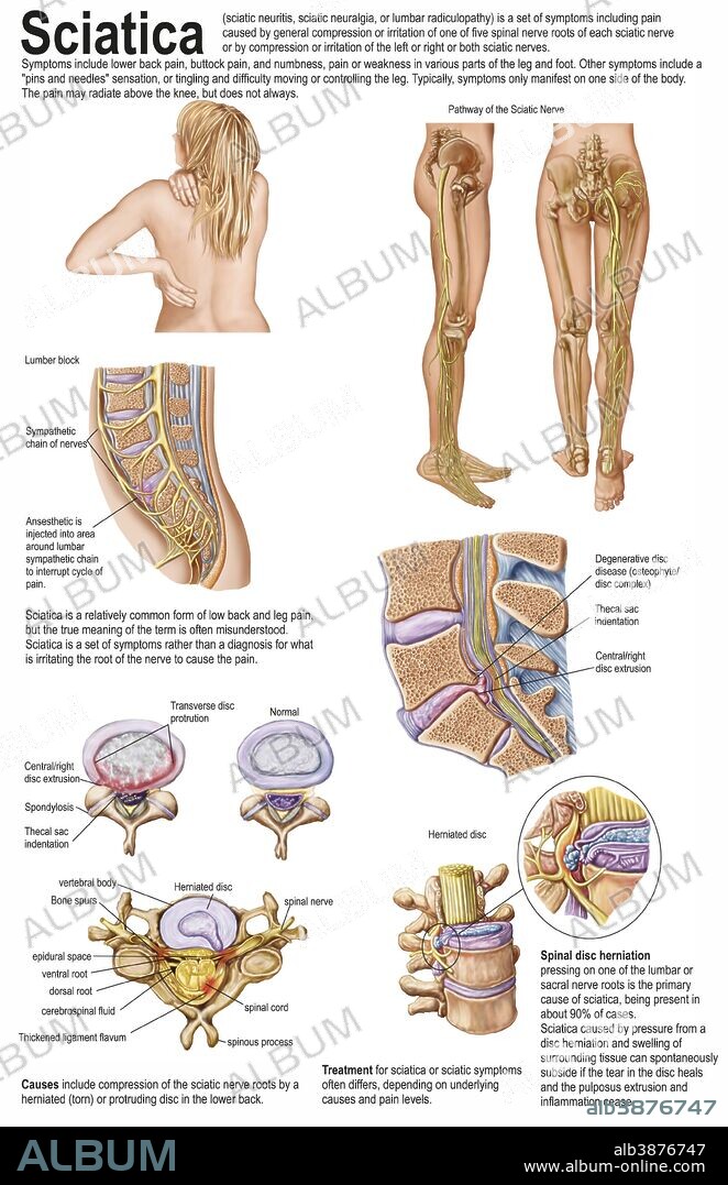 Medical chart showing the signs and symptoms of sciatica.