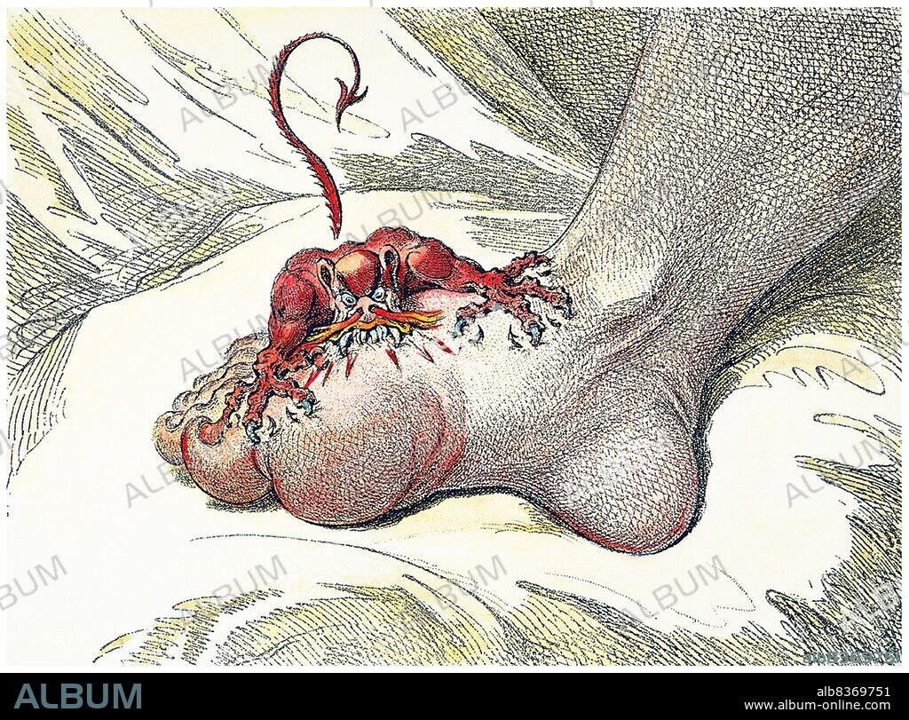 Gout (also known as podagra when it involves the big toe) is usually characterized by recurrent attacks of inflammatory arthritisa red, tender, hot, and swollen joint. Pain typically comes on rapidly in less than twelve hours. The joint at the base of the big toe is affected in about half of cases. It may also result in tophi, kidney stones, or urate nephropathy.<br/><br/>. James Gillray (13 August 1756 or 1757 1 June 1815) was an English caricaturist and printmaker famous for his etched political and social satires, mainly published between 1792 and 1810.