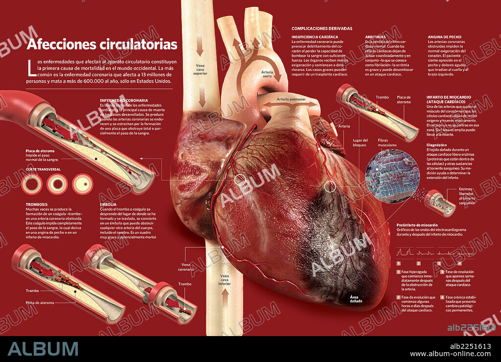 Afecciones circulatorias. Infografía sobre las múltiples enfermedades que afectan al aparato circulatorio: trombosis, embolia, enfermedad coronaria, insuficiencia cardíaca, arritmias….