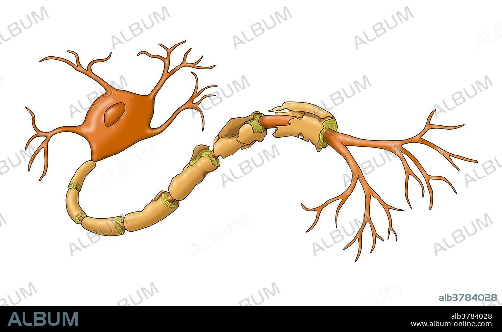 Demyelination. A demyelinating disease is any disease of the nervous system in which the myelin sheath of neurons is damaged.