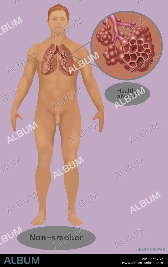 Illustration showing the healthy appearance of the lungs and alveoli in a non-smoker.