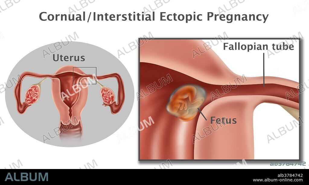 Illustration of a cornual/interstitial ectopic pregnancy. In an interstitial ectopic pregnancy the fetus grows outside of the uterine cavity. If the pregnancy goes undetected the fallopian tube will eventually burst, causing hemorrhaging into the mother's abdomen, which may be fatal. Surgery is performed to remove the fetus and repair or remove the Fallopian tube. In the image shown, at left is the entire uterus with a box around the area where the fetus is growing. At right is a close up of the fetus in the passageway to the fallopian tube.