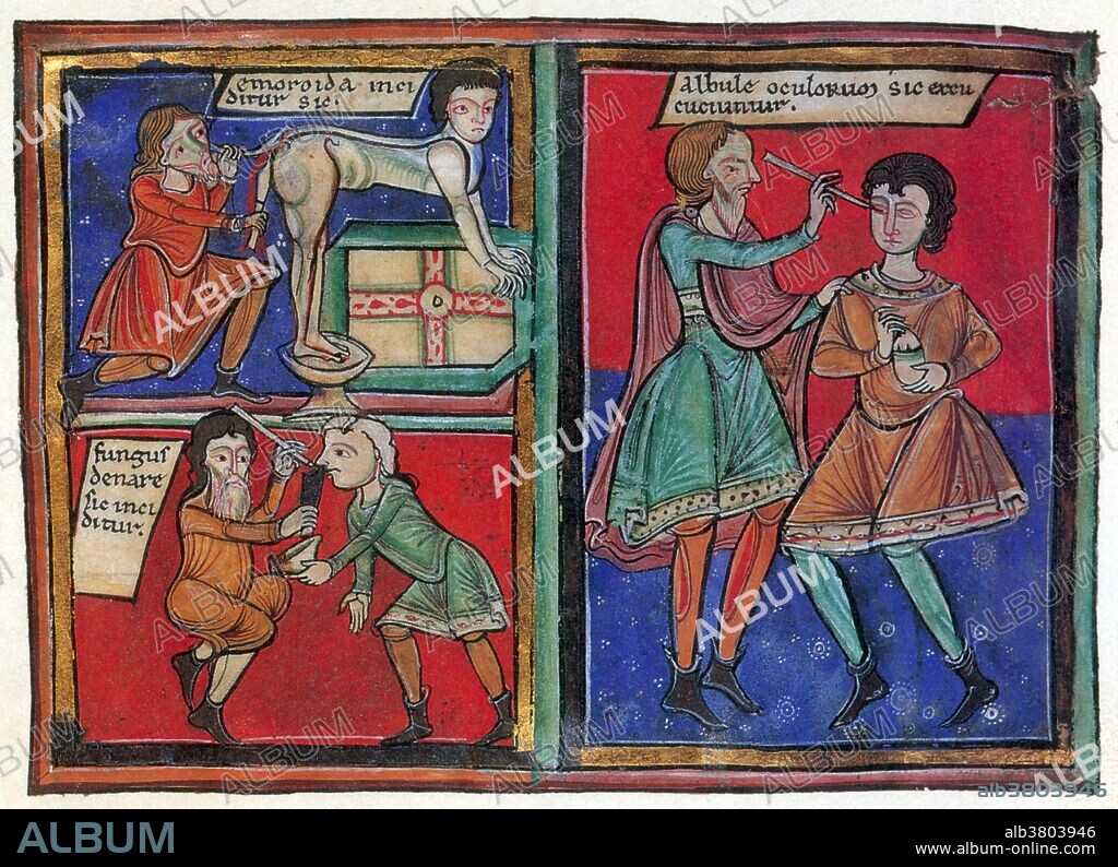 Rogerius (1140 - 1195), also known as Roger of Salerno, brought academic respectability to the discipline of surgery through the hugely popular work on the subject that is attributed to him. Practica Chirurgia or The Practice of Surgery was actually compiled by his students from his lecture notes. Surgery brought about a renaissance in European medical writing and promoted innovations in antiseptic, anesthetic, diagnostic and surgical practices. It describes various activities of the medieval Dispensary, a place where remedies were prepared and applied, diagnoses made and surgeries performed by the doctor and his assistants.