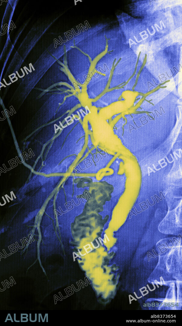 Cholangiography (Radiography of the biliary airways previously opacified with a iodined contrast media water-soluble administered through Kehr drain).. Normal radiologic appearance.