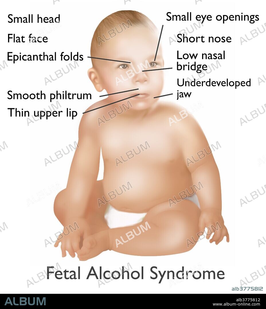 Illustration of baby with Fetal Alcohol Syndrome. Fetal Alcohol Syndrome or (FAS) is a condition in infants that is caused by alcohol consumption by the mother during time of pregnancy. Mental and physical defects such as a small head, flat face, epicanthal folds, smooth philtrum, thin upper lip, small eye openings, short nose, low nasal bridge, and underdeveloped jaw, are common symptoms of fetal exposure to alcohol.