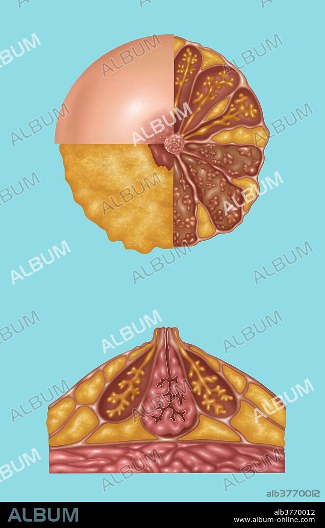 Illustration detailing the anatomy of a female breast from a front view (top) and a side view (bottom). The top image is in three sections. The areola, montgomery's tubercules, and nipple are in the light pink section. The nipple and subareolar musculature and subcutaneous fat are in the orange section. On the right half is: mammary fat (orange), lactiferous ducts (orange stems), acini (end of orange stems), ampulla (on orange stem), coopers ligaments (light pink strands), lobe and lobules (brown outlines and pink groups inside the brown), and interlobular connective tissue (brown area). The bottom image shows montgomery's gland and superficial fascia (outer lining), subcutaneous fat (orange outer sections), ampulla and lactiferous duct and connective tissue (pink center), coopers ligaments, mammary fat (orange bottom sections), pectoral fascia, and pectoralis major (pink at bottom).