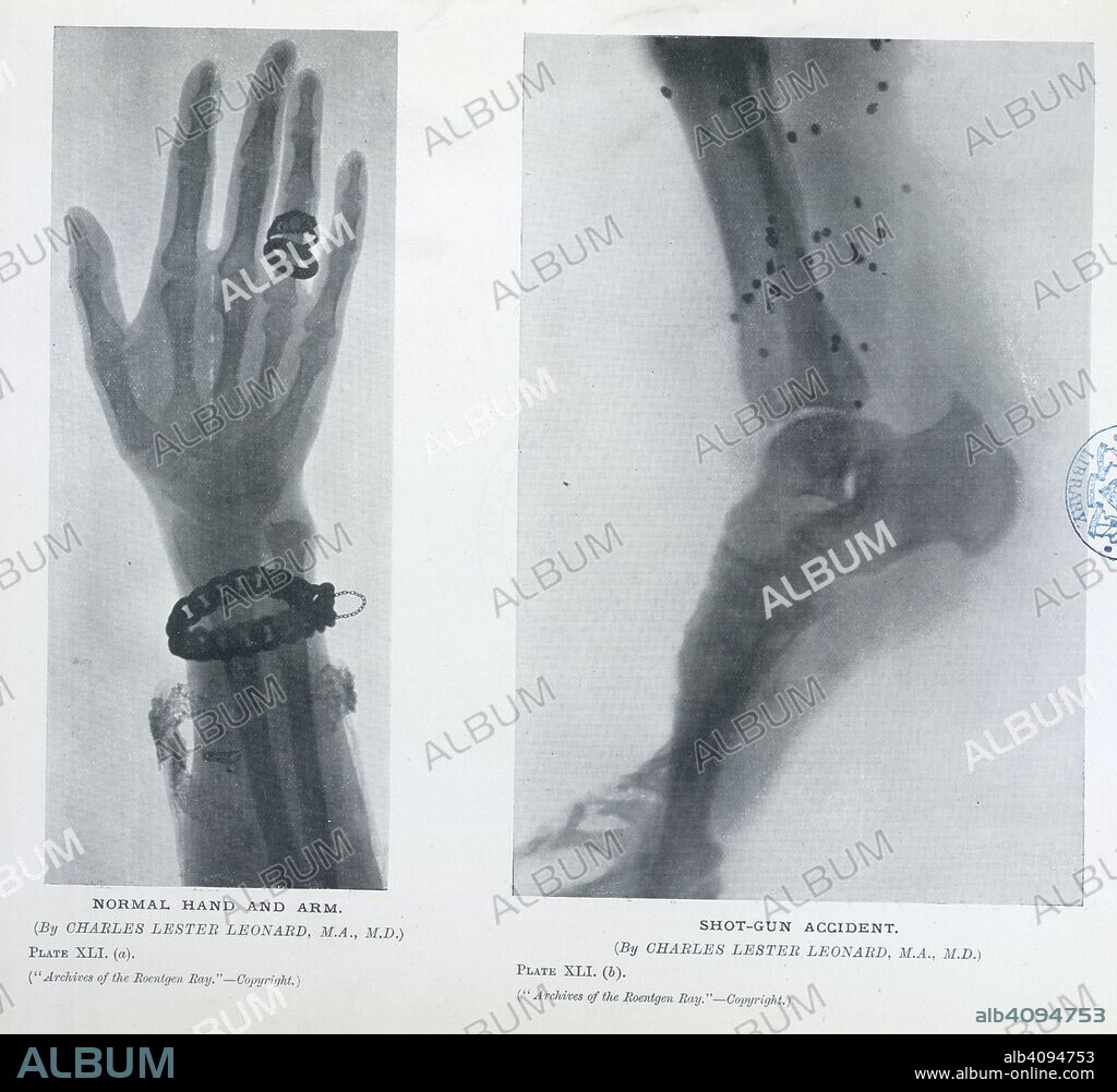Plate XLI. (a). Normal hand and arm. (By Charles Lester Leonard, M.A; M.D.) Plate XLI. (b). Shot-gun accident. Archives of the Roentgen ray. London : Heinemann, 1897-1915. Source: 1640.750000 vol. ii 113.