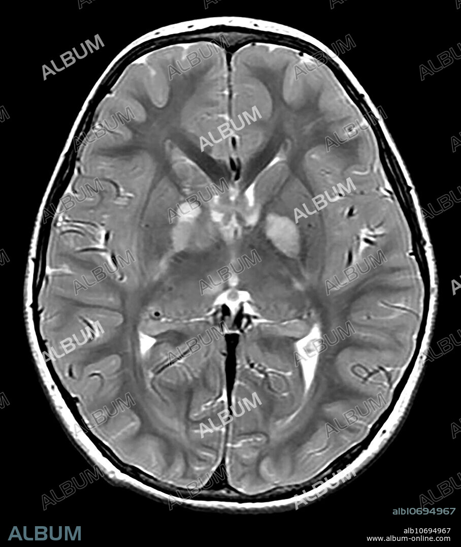 This axial (cross section) T2 weighted MRI of a 15 year old with known NF1 demonstrates the typical appearance of foci of abnormal increased T2 signal within the basal ganglia, internal capsule and thalamus commonly seen in NF1. These foci usually wax and wane and disappear as the subject approaches the age of 20.
