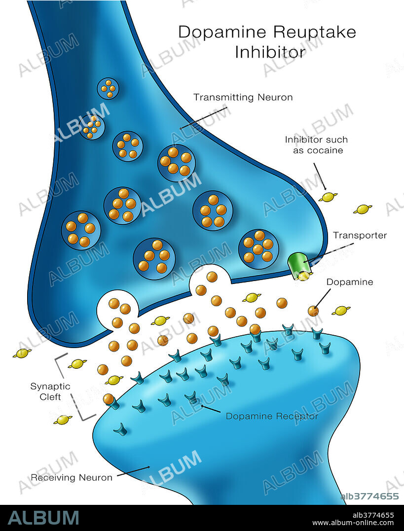 Labelled illustration showing the effect of a dopamine reuptake inhibitor (DRI), a type of drug used to treat conditions like ADHD and depression, on the action of a dopamine transporter.