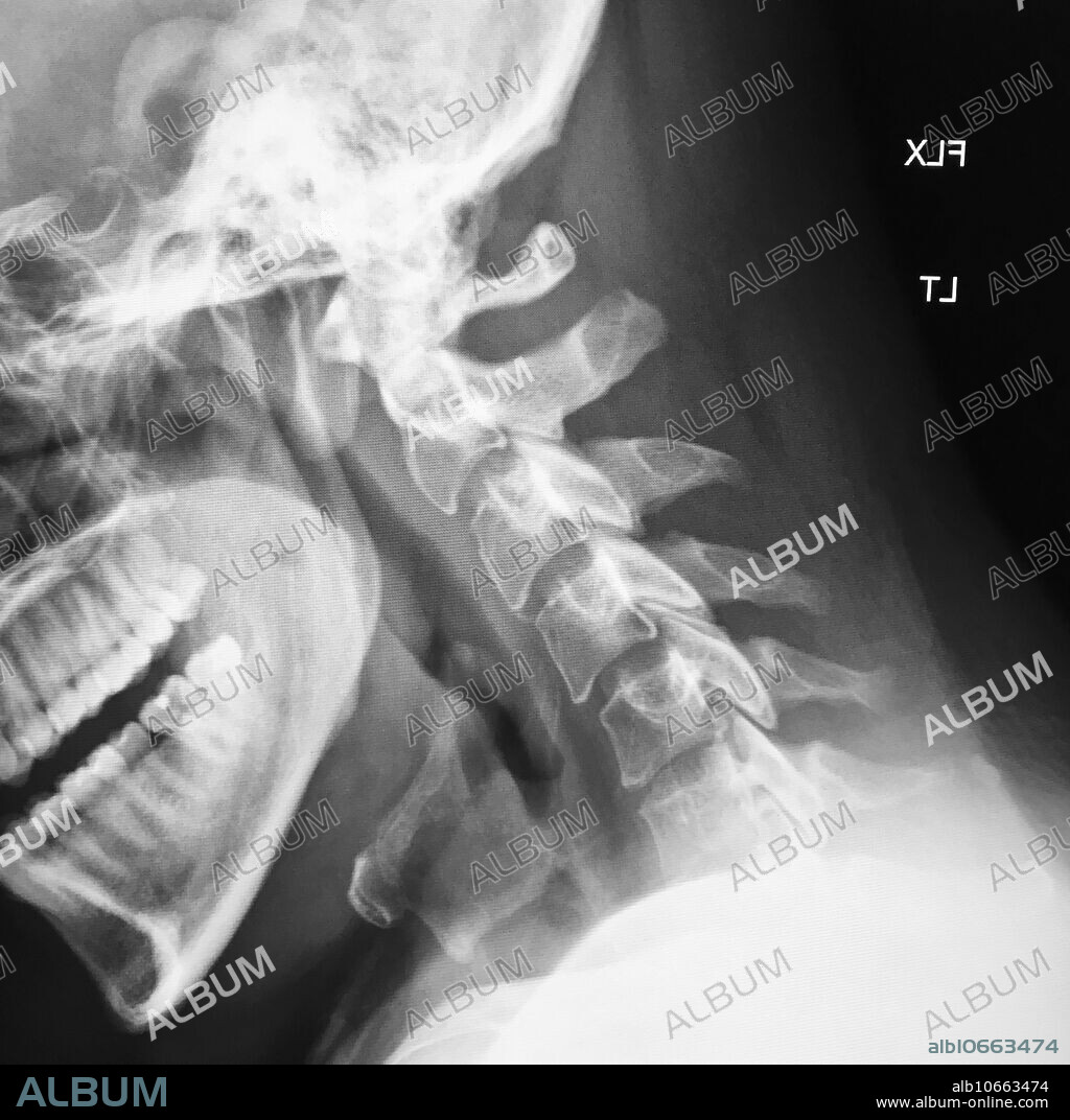 This is a normal lateral x-ray of the cervical spine with the patients head flexed.