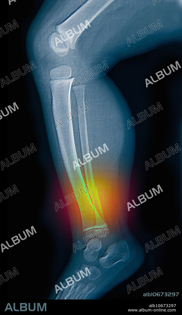 This X-ray shows greenstick fractures of the tibia and fibula in a 2 year old female, which in this case is the result of child abuse.