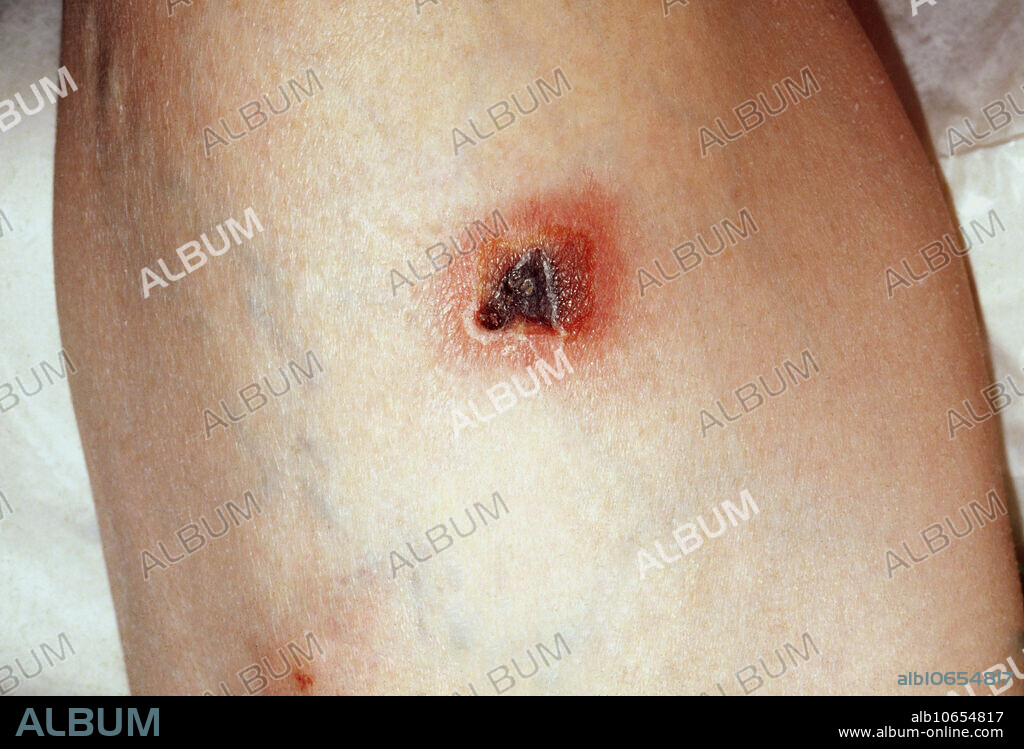 Ecthyma gangrenosum, and infection caused by Pseudomonas aeruginosa , staph infection invading into the superficial dermis, in this case the earlobe. With this condition, ulcers form on the skin due to bacteria such as Streptococcus pyogenes, Pseudomonas and Staphylococcus aureus.