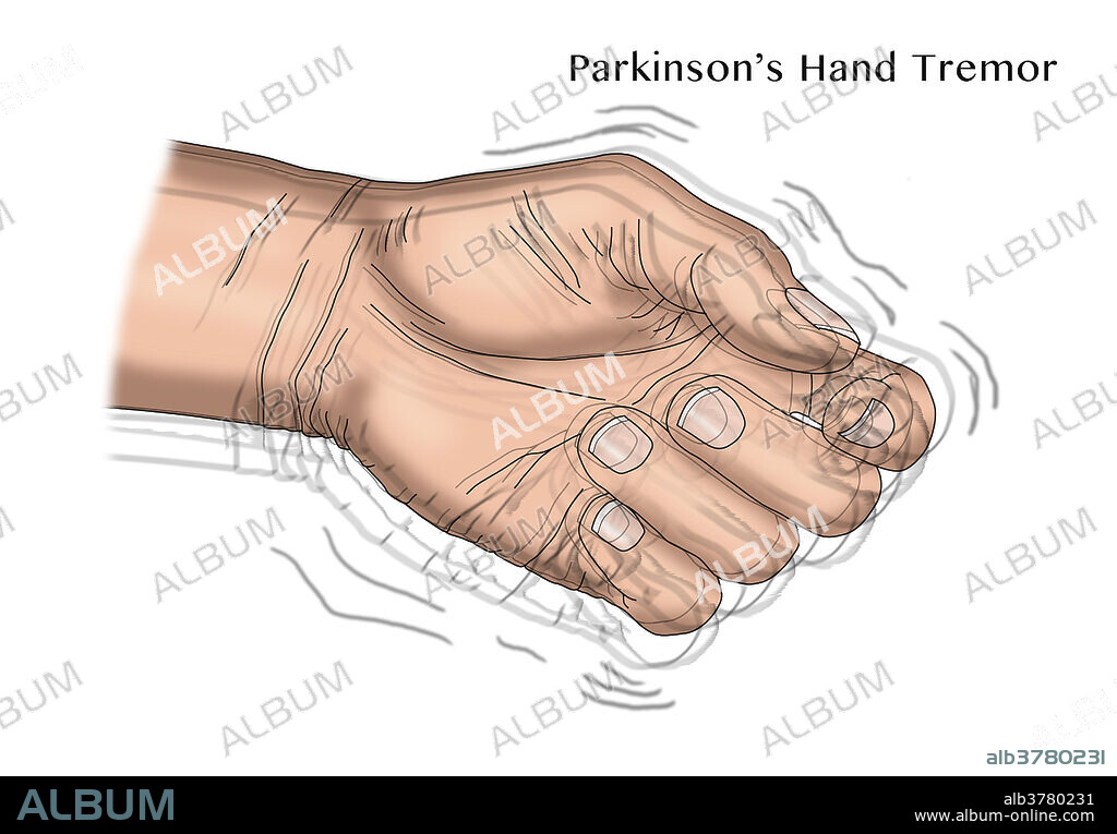 Parkinson's disease hand showing pill-rolling Tremor symptom, Illustration