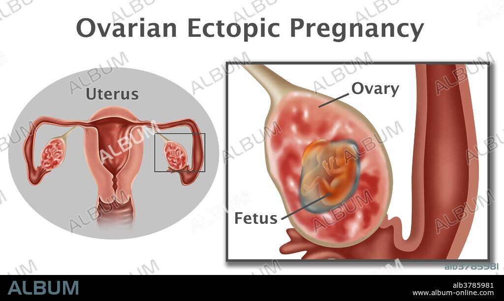 Illustration of an ovarian pregnancy. This is a type of ectopic pregnancy where the fetus grows inside the ovary instead of the uterus. In the image shown, at left is the uterus with a box around the ovary where the fetus is growing. At right is a close up of the fetus growing inside an ovary.