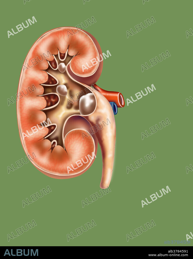 A kidney stone, also known as a renal calculus is a solid concretion or crystal aggregation formed in the kidneys from dietary minerals in the urine. Urinary stones are typically classified by their location in the kidney (nephrolithiasis), ureter (ureterolithiasis), or bladder (cystolithiasis), or by their chemical composition (calcium-containing, struvite, uric acid, or other compounds). Kidney stones typically leave the body by passage in the urine stream, and many stones are formed and passed without causing symptoms. If stones grow to sufficient size they can cause obstruction of the ureter. Ureteral obstruction causes postrenal azotaemia and hydronephrosis (distension and dilation of the renal pelvis and calyces), as well as spasm of the ureter. This leads to pain, most commonly felt in the flank (the area between the ribs and hip), lower abdomen and groin (a condition called renal colic).When a stone causes no symptoms, watchful waiting is a.