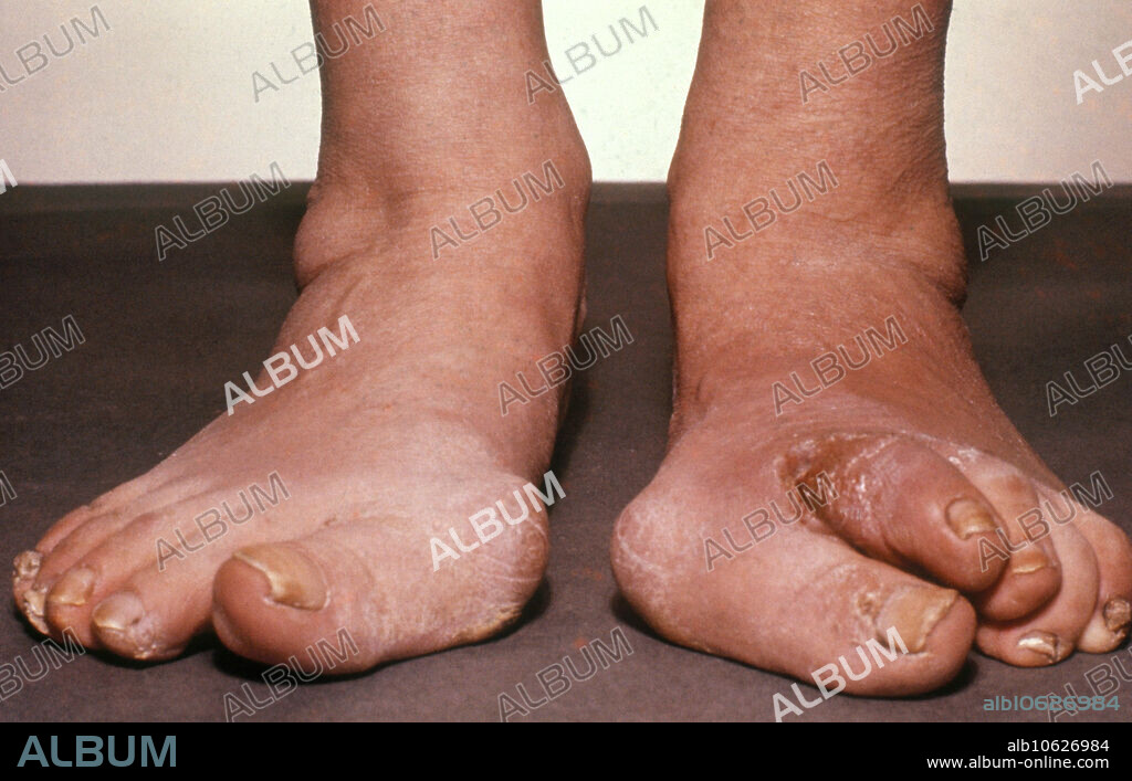 Dislocated toes in a patient with Tabes dorsalis (locomotor ataxia), a slow degeneration of the sensory neurons that carry information. The disease is caused by demyelination secondary to an untreated syphilis infection.