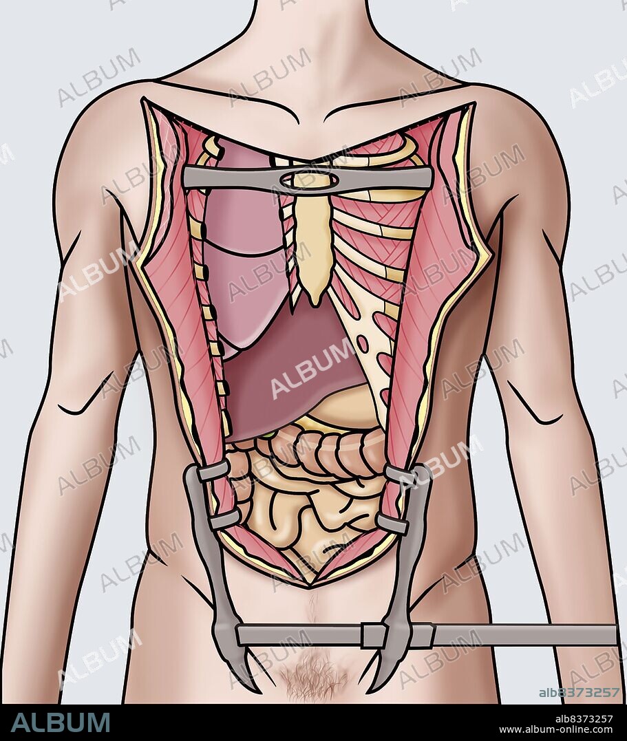 Illustration showing the opening of the thorax and abdomen during an autopsy in order to reach the various organs to be studied.