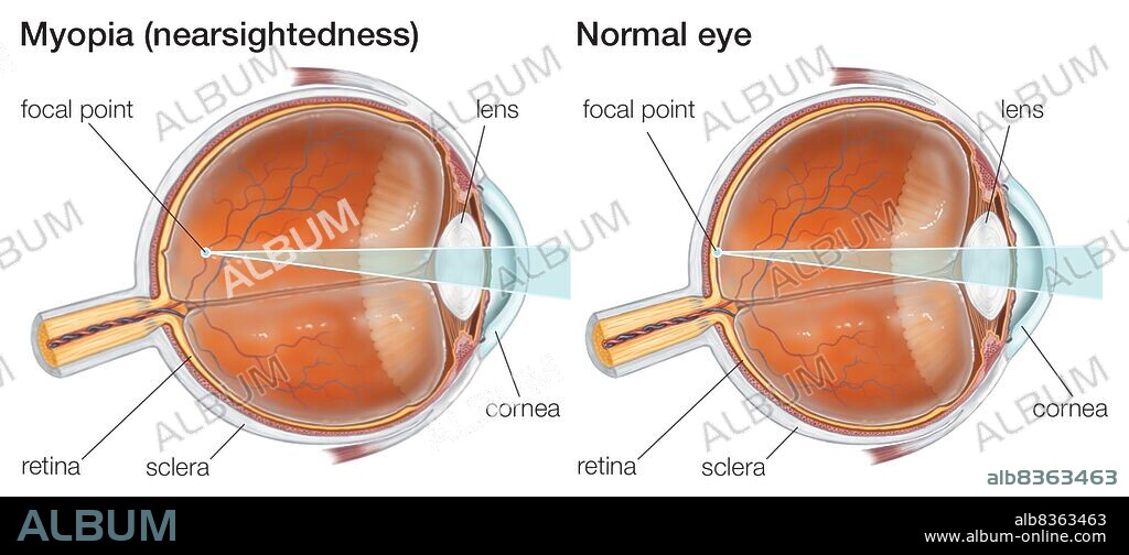 Myopia, or nearsightedness, can be corrected with concave lenses to allow near objects to be brought into focus by the eye.