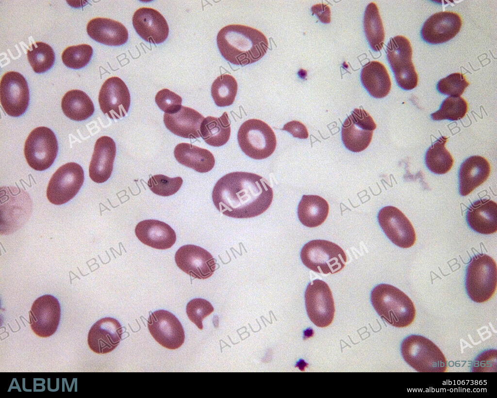 Stomatocytes are abnormal red blood cells in which a slit or mouthlike area replaces the normal central circle of pallor, often due to edema. Light micrograph, Wright-Giemsa stain. Magnification: 100x.