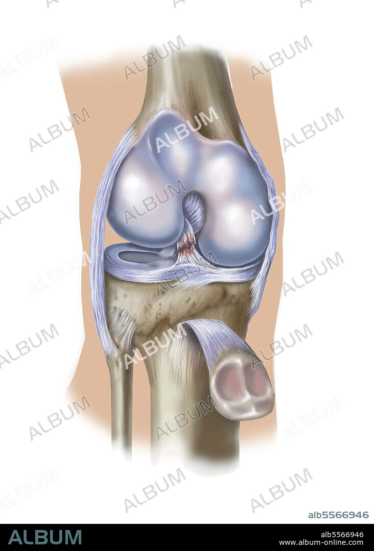 Front view of knee showing anterior cruciate ligament tear.