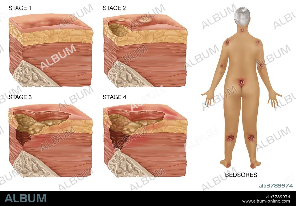 Illustrations showing the 4 stages of a bedsore or pressure sore in layers of epidermis and on the human body. Bedsores can be caused by many factors including unrelieved pressure, friction, humidity, etc. Bedsores usually afflict the frail and elderly, wheelchair bound people and the terminally ill. Bedsores can be fatal but can be treated and cured by a regimen of relieving pressure by turning the body on a strict schedule.