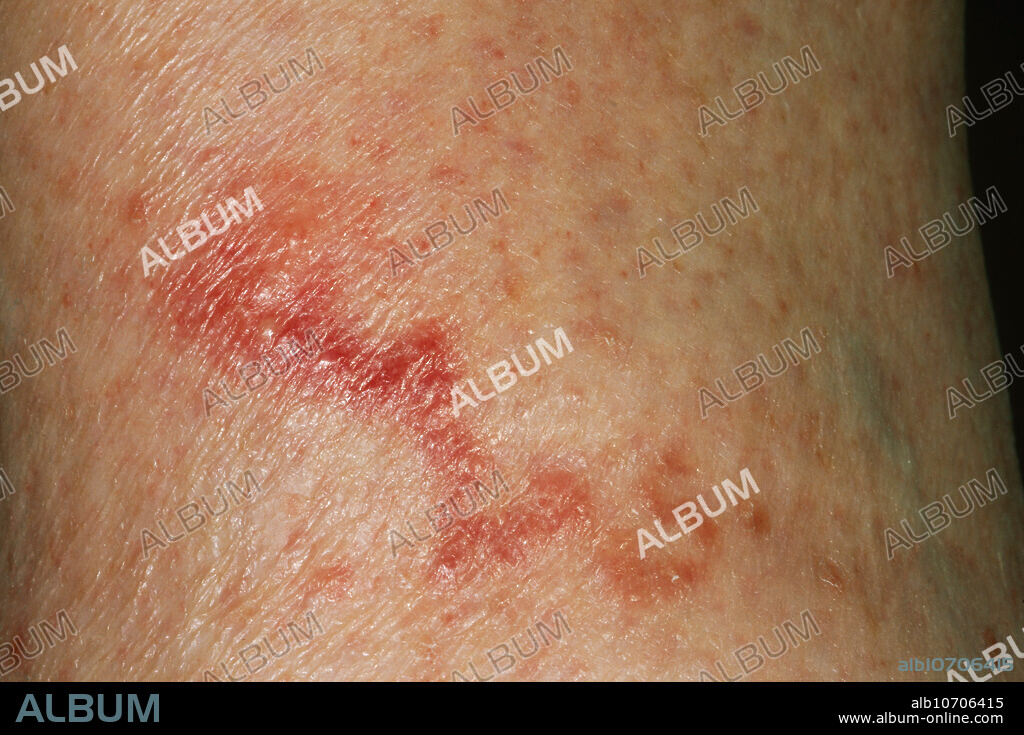 Cutaneous larva migrans (creeping eruption) trail of hookworm (Ancylostoma duodenale). Ancylostoma is a parasitic nematode which lives in the small intestine of a variety of mammals including humans, dogs, cats, and wild carnivores. Ankylostomiasis is the disease caused by hookworm. It is caused when multitudes of hookworms produce an iron deficiency anemia by sucking blood from the host's intestinal walls. The name is derived from Greek ''ancylo'' meaning ''crooked'' and ''stoma'' meaning ''mouth.'' Hookworm is a leading cause of maternal and child morbidity in the developing countries of the tropics and subtropics.